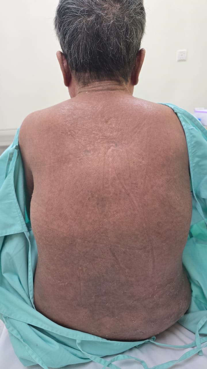 Eczema after treatment showing improvement
